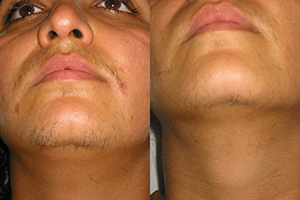 VEDANT Laser & Cosmetics Surgery Centre Gwalior VEDANT Laser & Cosmetics Surgery Centre Gwalior